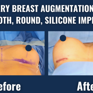 Visual comparison showing before and after results of primary breast augmentation with smooth, round silicone implants, highlighting improved breast volume and natural-looking enhancement.