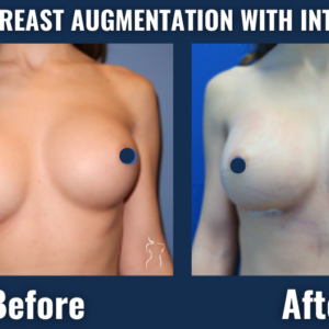 Before and after results of revision breast augmentation with internal bra support showing improved breast symmetry and implant stability.