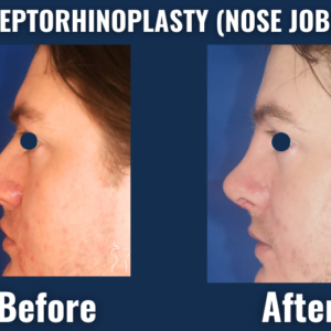 Visual comparison of septorhinoplasty results showing improved nasal structure and facial balance, with natural-looking surgical outcomes