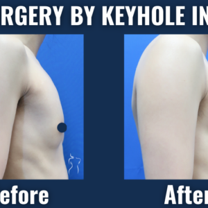 Before and after photos of top surgery using keyhole incision technique showing subtle, scar-minimized chest masculinization in an ftm patient.