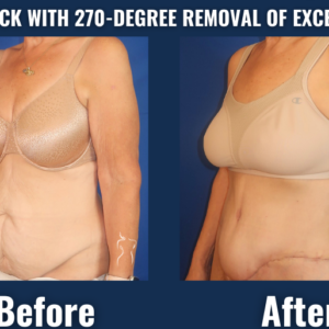 Visual comparison demonstrating transformative results of a 270-degree tummy tuck procedure with comprehensive tissue removal, revealing improved abdominal tightness and waistline contour.