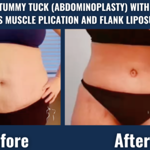 Visual comparison of a patient before and after tummy tuck surgery with rectus muscle repair and flank liposuction, demonstrating improved abdominal contour and waist definition.