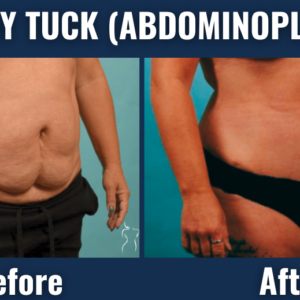 Before and after results of tummy tuck (abdominoplasty) showing removal of excess abdominal skin and improved waistline in a female patient.
