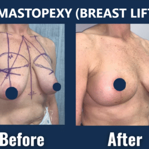 Before and after photos of a female patient following a mastopexy (breast lift) procedure.