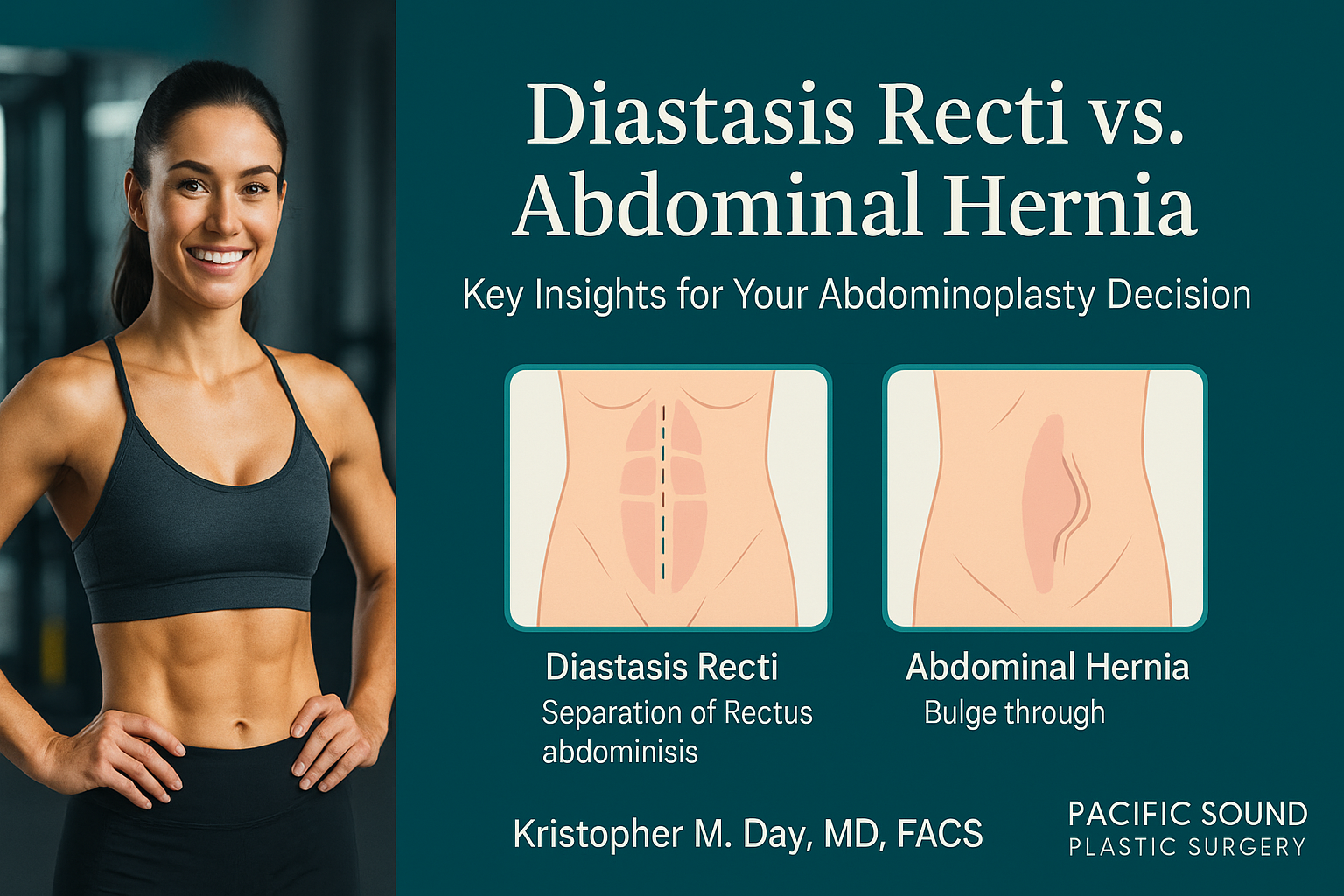 Understanding Diastasis Recti Vs. Abdominal Hernia: Key Insights For Your Abdominoplasty Decision 1 Infographic comparing diastasis recti (midline muscle separation) and abdominal hernia (fascial defect with tissue protrusion), with a fit woman at left and two abdominal diagrams at right.