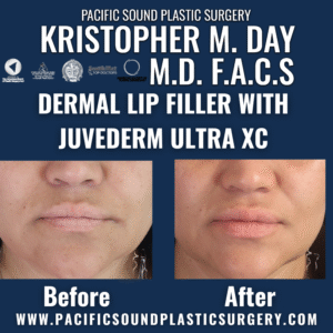 Before and after dermal lip filler with juvéderm ultra xc showing enhanced lip volume and definition at pacific sound plastic surgery in bellevue, wa.