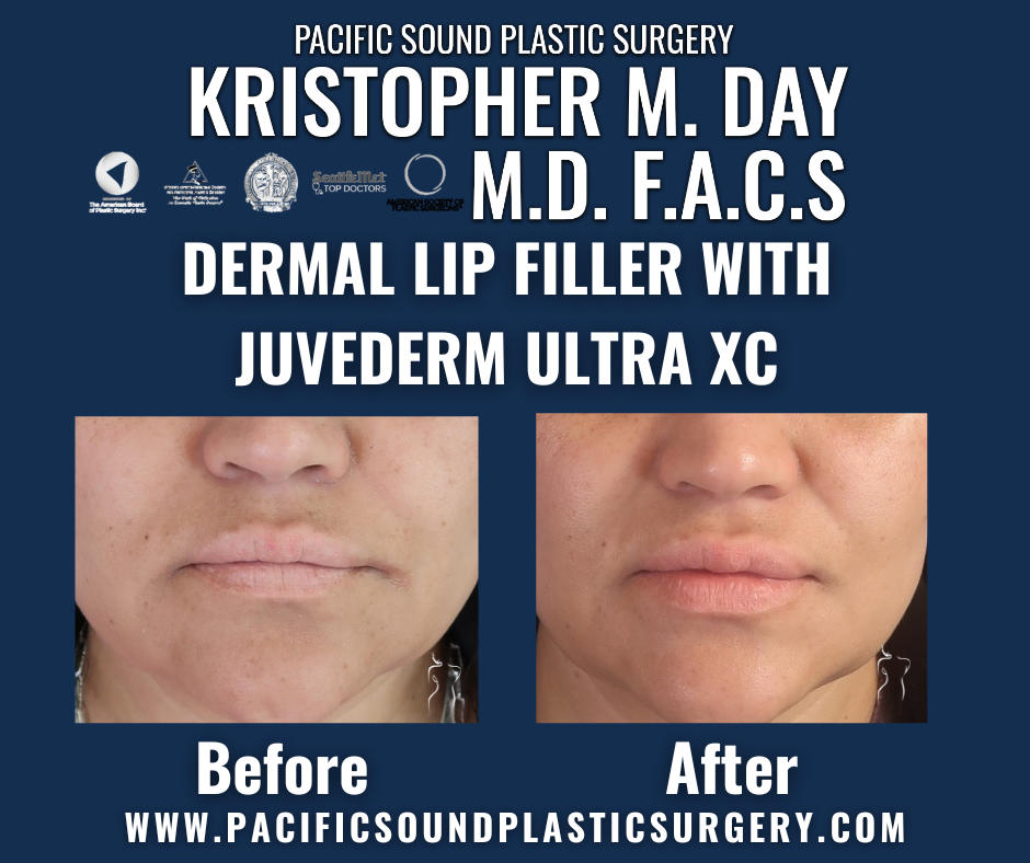 Before and after dermal lip filler with juvéderm ultra xc showing enhanced lip volume and definition at pacific sound plastic surgery in bellevue, wa.