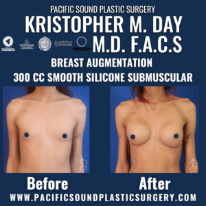 Before and after breast augmentation with 300cc smooth silicone implants placed submuscularly at pacific sound plastic surgery in bellevue, wa.