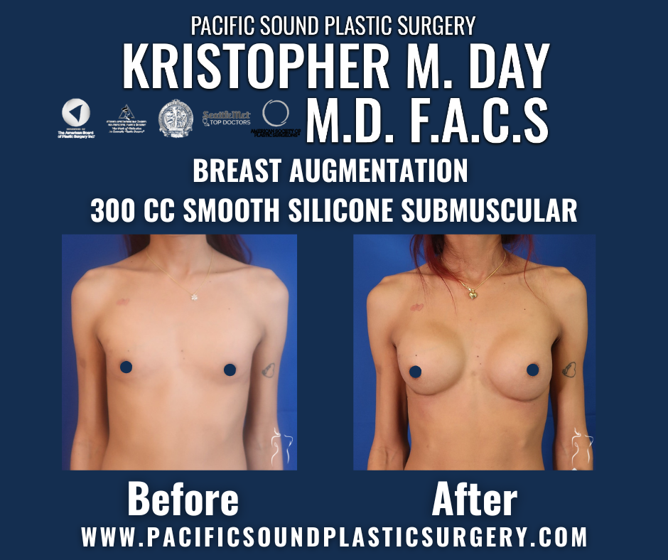 Before and after breast augmentation with 300cc smooth silicone implants placed submuscularly at pacific sound plastic surgery in bellevue, wa.