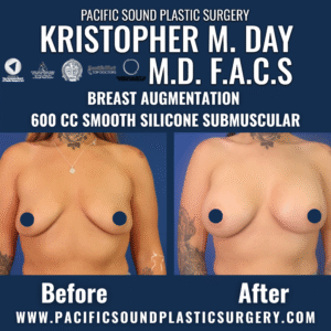 Before and after breast augmentation with 600cc smooth silicone implants placed submuscularly at pacific sound plastic surgery in bellevue, wa.