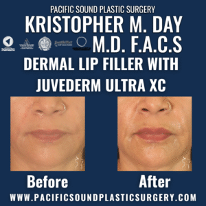 Before and after dermal lip filler with juvéderm ultra xc showing improved lip volume and definition at pacific sound plastic surgery in bellevue, wa.
