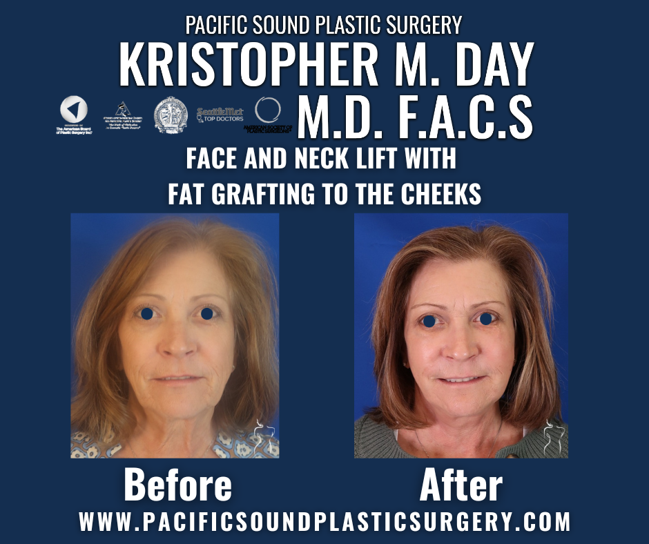 Before and after face and neck lift with fat grafting to the cheeks at pacific sound plastic surgery in bellevue, wa.