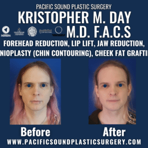 Before and after facial feminization surgery including forehead reduction, lip lift, jaw reduction, genioplasty (chin contouring), and cheek fat grafting at pacific sound plastic surgery in bellevue, wa.