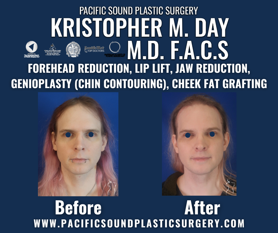 Before and after facial feminization surgery including forehead reduction, lip lift, jaw reduction, genioplasty (chin contouring), and cheek fat grafting at pacific sound plastic surgery in bellevue, wa.