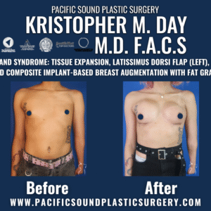 Before and after poland syndrome breast reconstruction with tissue expansion, left latissimus dorsi flap, staged implant-based augmentation, and fat grafting at pacific sound plastic surgery in bellevue, wa.