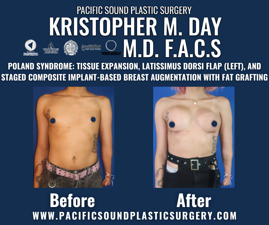 Before and after poland syndrome breast reconstruction with tissue expansion, left latissimus dorsi flap, staged implant-based augmentation, and fat grafting at pacific sound plastic surgery in bellevue, wa.