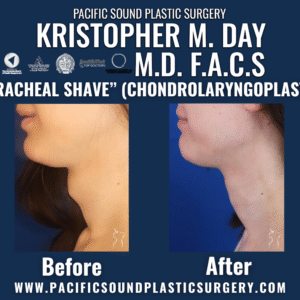 Before and after tracheal shave (chondrolaryngoplasty) showing reduced adam’s apple contour at pacific sound plastic surgery in bellevue, wa.