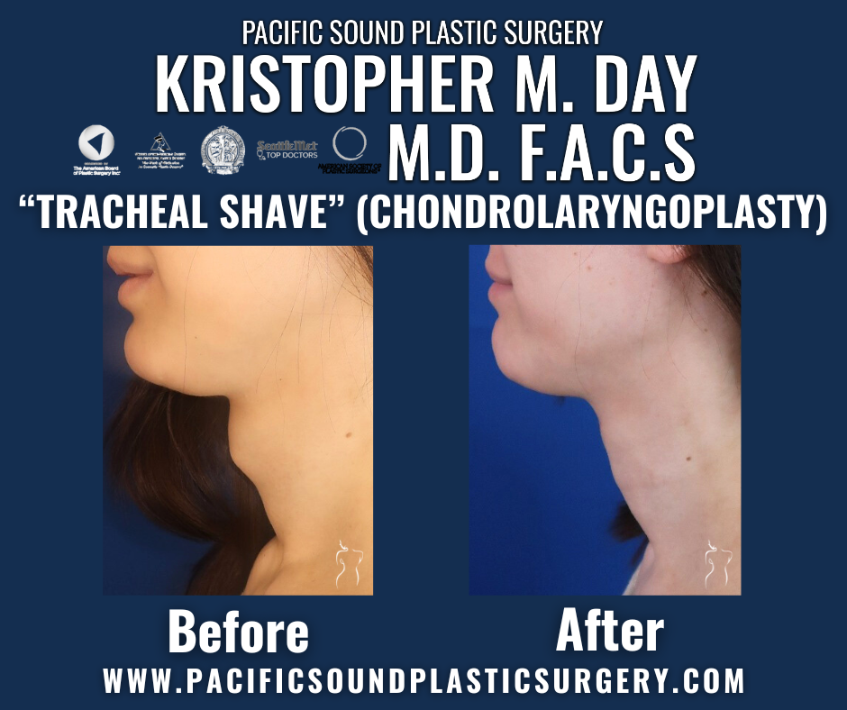 Before and after tracheal shave (chondrolaryngoplasty) showing reduced adam’s apple contour at pacific sound plastic surgery in bellevue, wa.